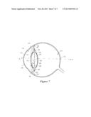 ACCOMMODATING INTRAOCULAR LENS DEVICE diagram and image