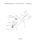 BI-DIRECTIONAL FIXATING TRANSVERTEBRAL BODY SCREWS AND POSTERIOR CERVICAL     AND LUMBAR INTERARTICULATING JOINT CALIBRATED STAPLING DEVICES FOR SPINAL     FUSION diagram and image