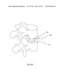 BI-DIRECTIONAL FIXATING TRANSVERTEBRAL BODY SCREWS AND POSTERIOR CERVICAL     AND LUMBAR INTERARTICULATING JOINT CALIBRATED STAPLING DEVICES FOR SPINAL     FUSION diagram and image