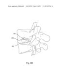 BI-DIRECTIONAL FIXATING TRANSVERTEBRAL BODY SCREWS AND POSTERIOR CERVICAL     AND LUMBAR INTERARTICULATING JOINT CALIBRATED STAPLING DEVICES FOR SPINAL     FUSION diagram and image