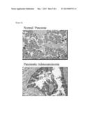 GENE FAMILY (LBFL313) ASSOCIATED WITH PANCREATIC CANCER diagram and image