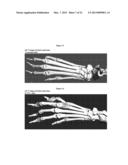 METHOD FOR TREATING AND PREVENTING ARTHRITIS diagram and image