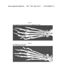 METHOD FOR TREATING AND PREVENTING ARTHRITIS diagram and image