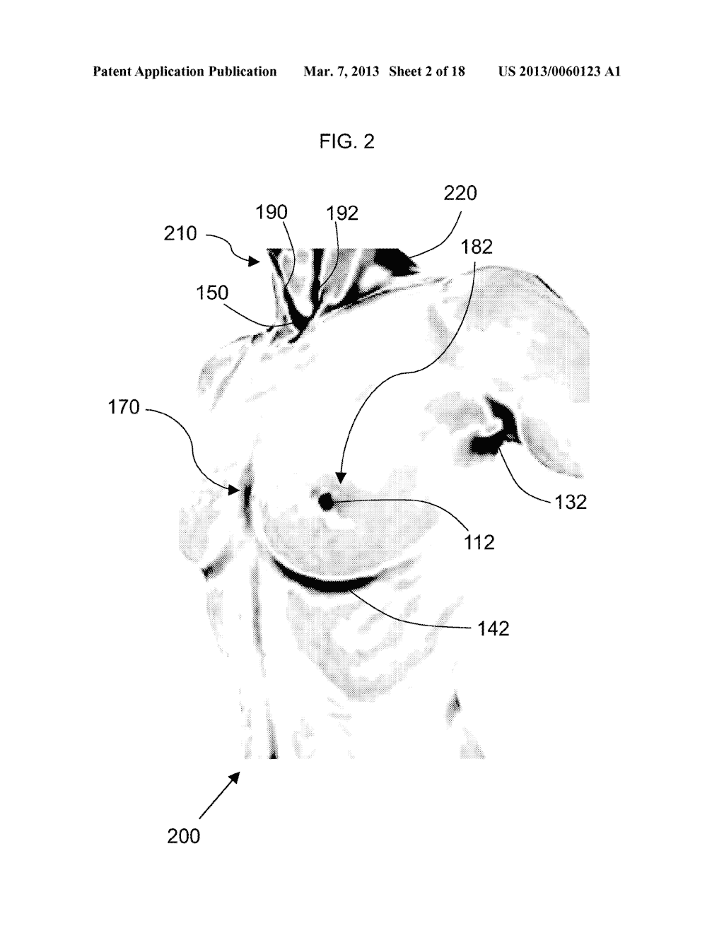 METHOD FOR DETERMINING BREAST VOLUME TO ASSIST MEDICAL PROCEDURE - diagram, schematic, and image 03