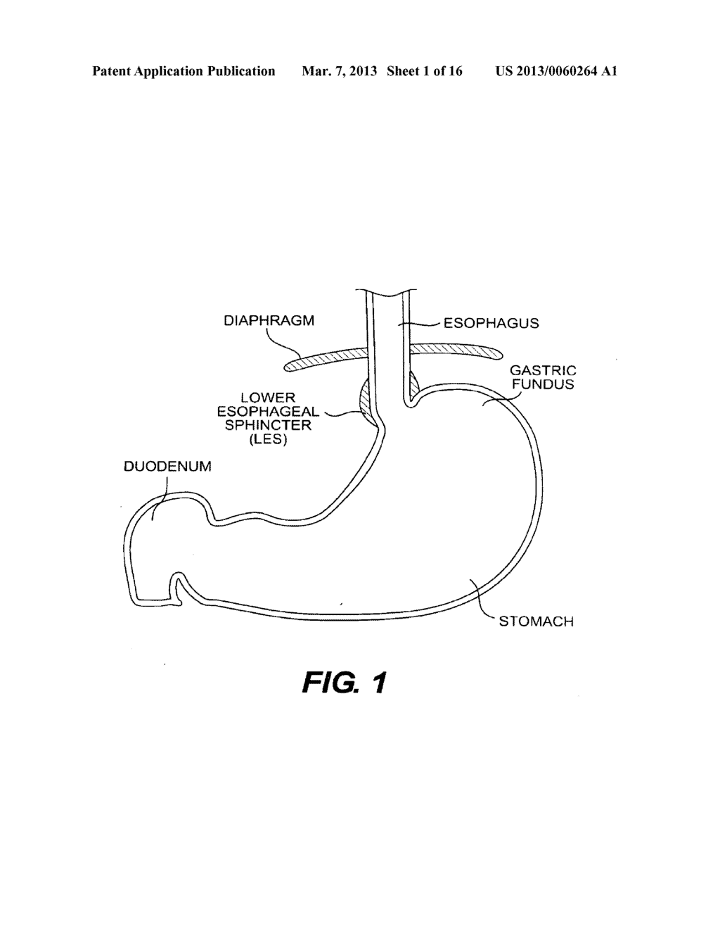 METHODS AND DEVICES FOR FOLDING AND SECURING TISSUE - diagram, schematic, and image 02