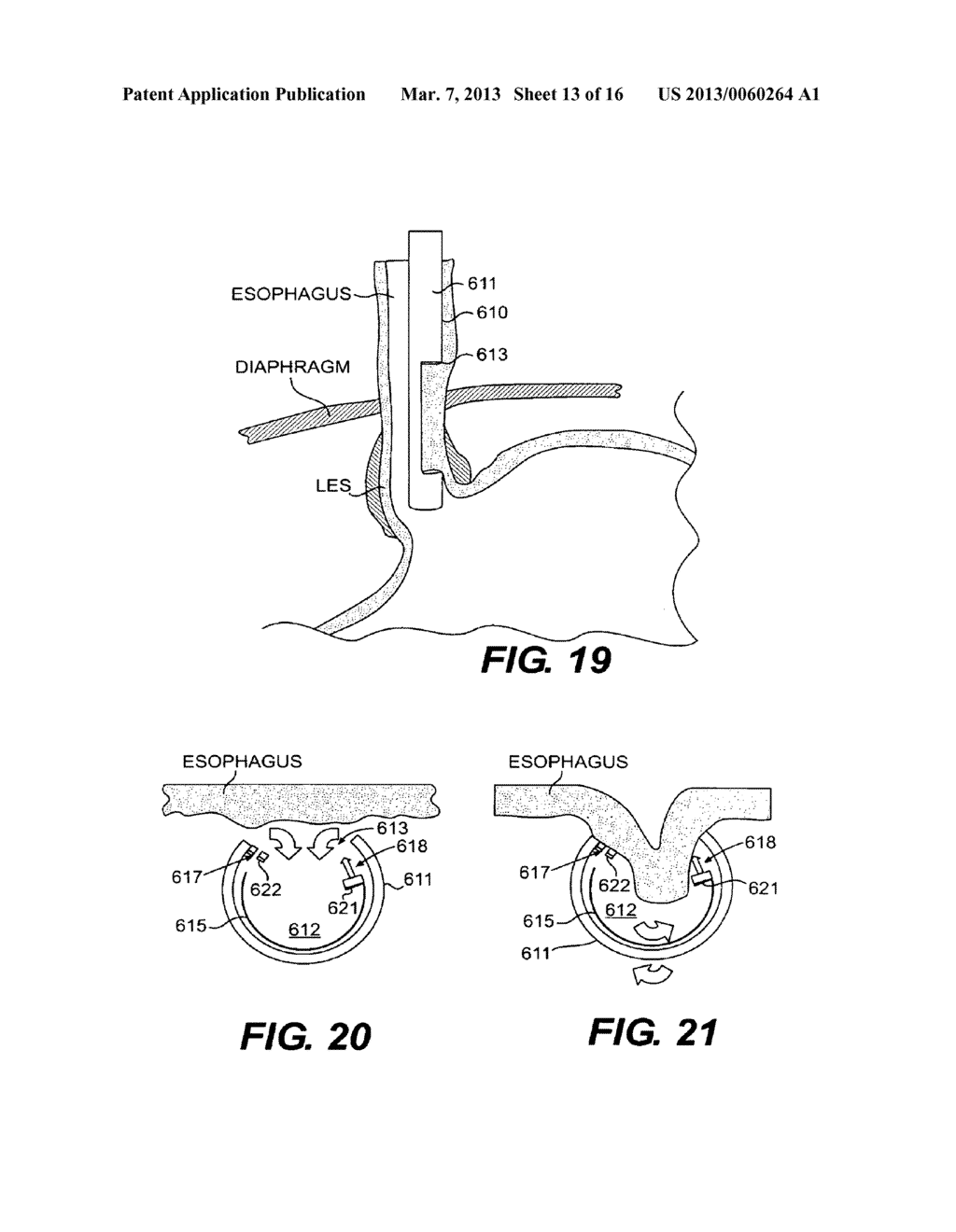 METHODS AND DEVICES FOR FOLDING AND SECURING TISSUE - diagram, schematic, and image 14