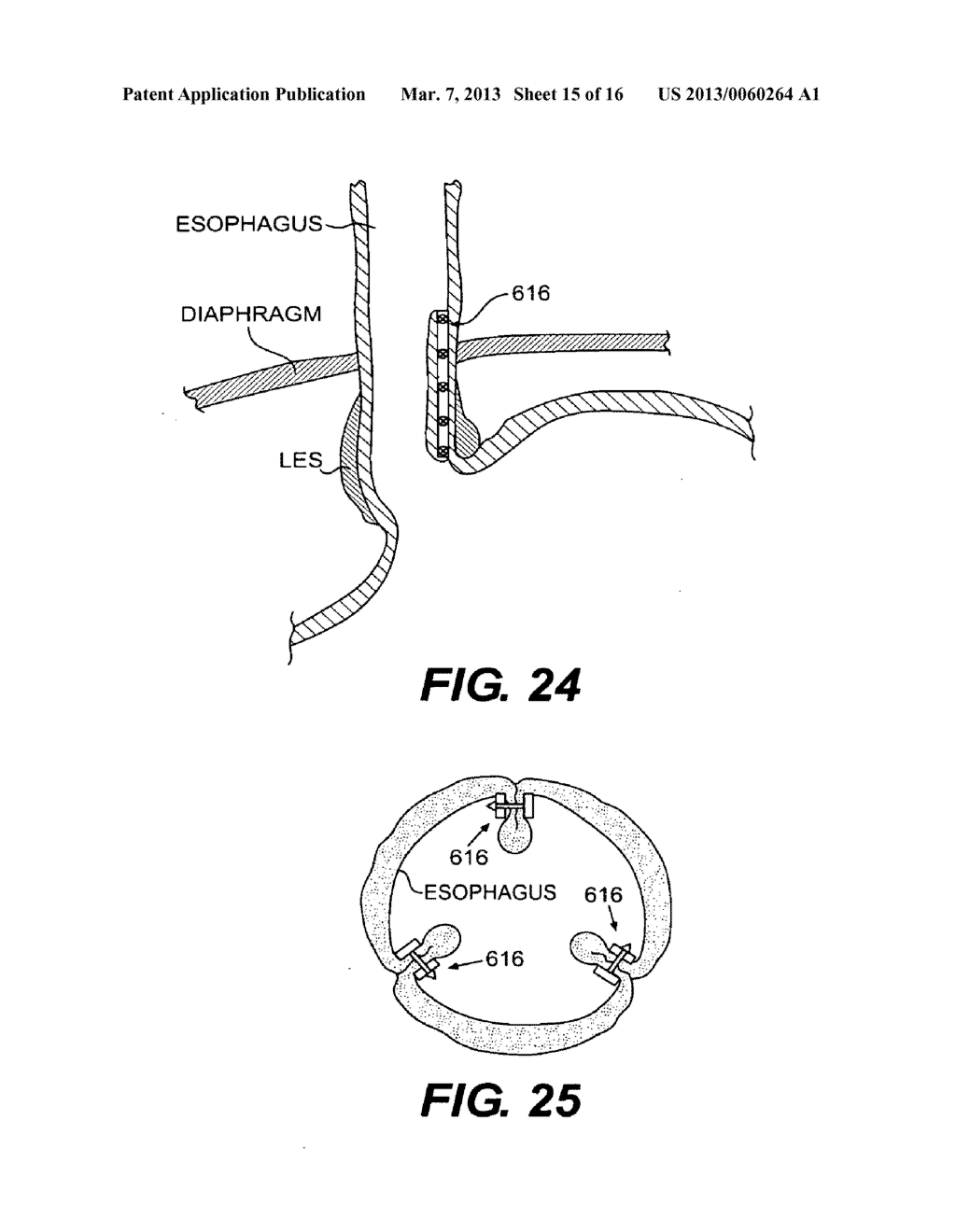 METHODS AND DEVICES FOR FOLDING AND SECURING TISSUE - diagram, schematic, and image 16