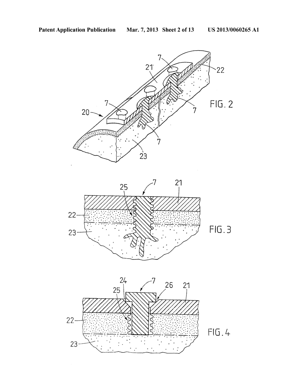 IMPLANTS FOR CREATING CONNECTIONS TO TISSUE PARTS, IN PARTICULAR TO     SKELETAL PARTS, AS WELL AS DEVICE AND METHOD FOR IMPLANTATION THEREOF - diagram, schematic, and image 03