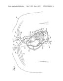 CANNULA TIPS, TISSUE ATTACHMENT RINGS, AND METHODS OF DELIVERING AND USING     THE SAME diagram and image