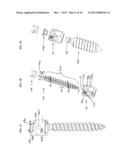 Bone Implants diagram and image