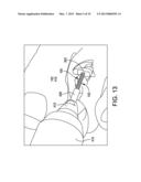 HAMMER TOE IMPLANT diagram and image