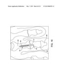 HAMMER TOE IMPLANT diagram and image