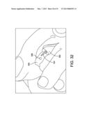 HAMMER TOE IMPLANT diagram and image