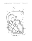 LEAD INCLUDING CONDUCTORS CONFIGURED FOR REDUCED MRI-INDUCED CURRENTS diagram and image