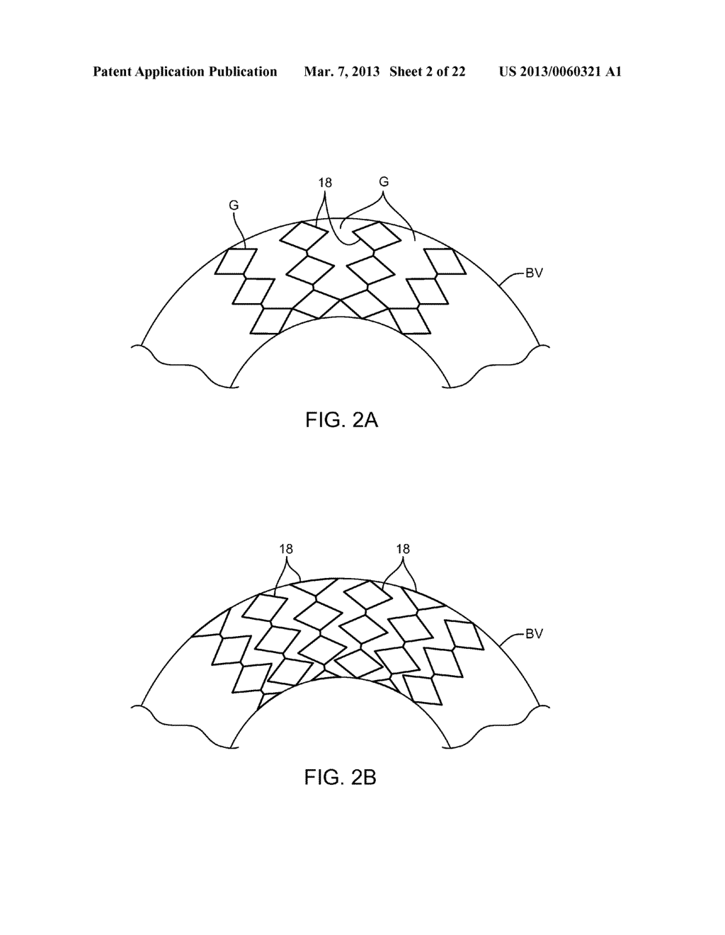 MULTIPLE INDEPENDENT NESTED STENT STRUCTURES AND METHODS FOR THEIR     PREPARATION AND DEPLOYMENT - diagram, schematic, and image 03