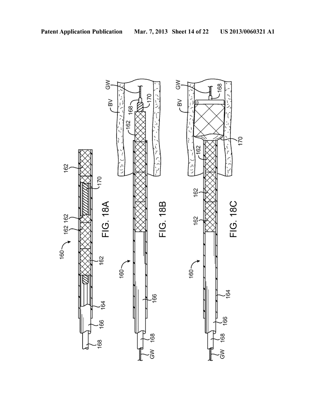 MULTIPLE INDEPENDENT NESTED STENT STRUCTURES AND METHODS FOR THEIR     PREPARATION AND DEPLOYMENT - diagram, schematic, and image 15