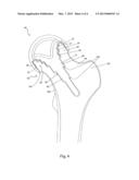 FEMORAL IMPLANT diagram and image