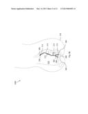 MEDICAL DEVICE AND METHODS OF DELIVERING THE MEDICAL DEVICE diagram and image