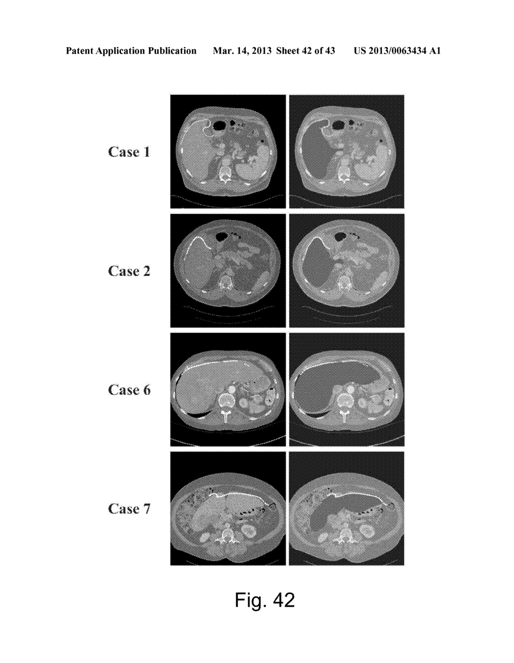 APPARATUS AND METHODS OF COMPENSATING FOR ORGAN DEFORMATION, REGISTRATION     OF INTERNAL STRUCTURES TO IMAGES, AND APPLICATIONS OF SAME - diagram, schematic, and image 43