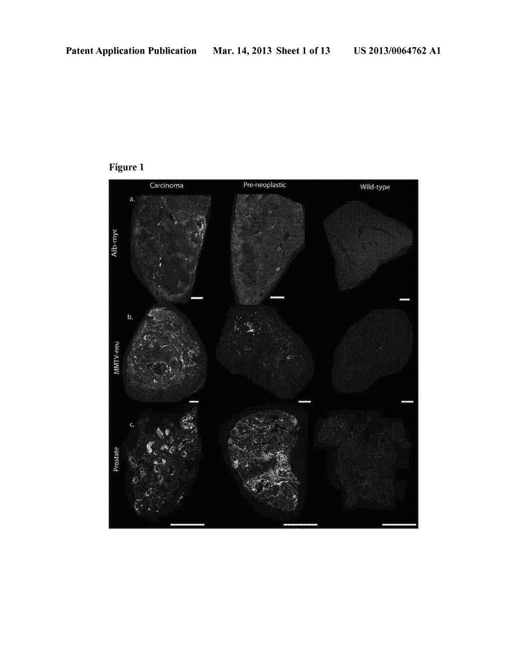 METHODS OF DETECTING AND TREATING CANCERS USING AUTOANTIBODIES - diagram, schematic, and image 02