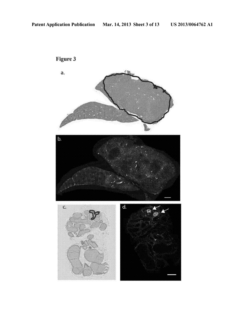 METHODS OF DETECTING AND TREATING CANCERS USING AUTOANTIBODIES - diagram, schematic, and image 04