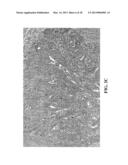 GENE EXPRESSION PROFILING FOR CLASSIFYING AND TREATING GASTRIC CANCER diagram and image