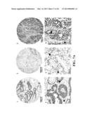 GENE EXPRESSION PROFILING FOR CLASSIFYING AND TREATING GASTRIC CANCER diagram and image