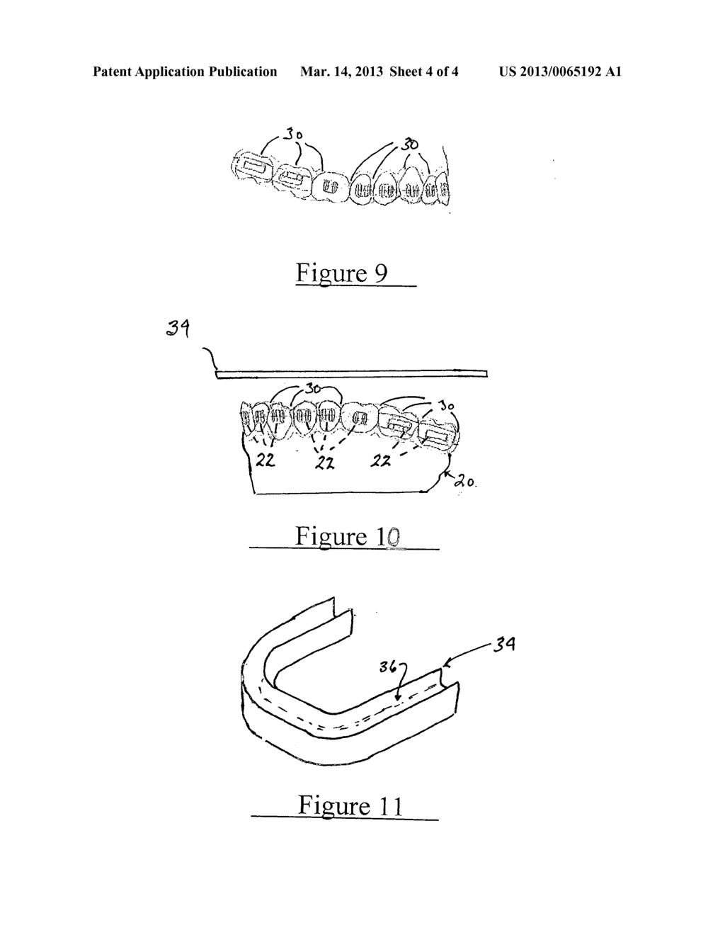 Procedure and device for enabling a dental element to be applied to a     dental arch - diagram, schematic, and image 05