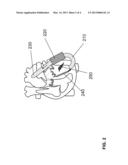 IMPLANTABLE CARDIAC THERAPY DEVICE diagram and image