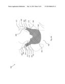 MEDICAL DEVICE AND METHODS OF DELIVERING THE MEDICAL DEVICE diagram and image