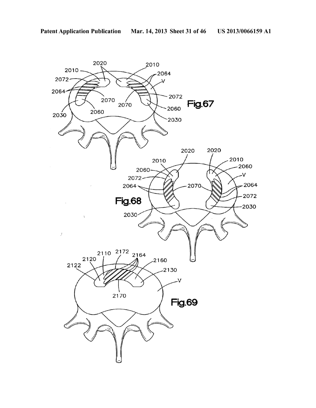 METHOD FOR SECURING VERTEBRAE - diagram, schematic, and image 32