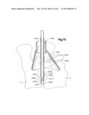 METHOD FOR SECURING VERTEBRAE diagram and image