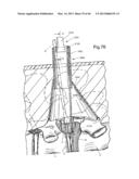 METHOD FOR SECURING VERTEBRAE diagram and image