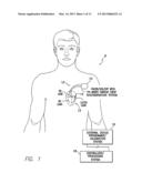 SYSTEMS AND METHODS FOR DETECTING FAR-FIELD OVERSENSING BASED ON SIGNALS     SENSED BY THE PROXIMAL ELECTRODE OF A MULTIPOLAR LV LEAD diagram and image