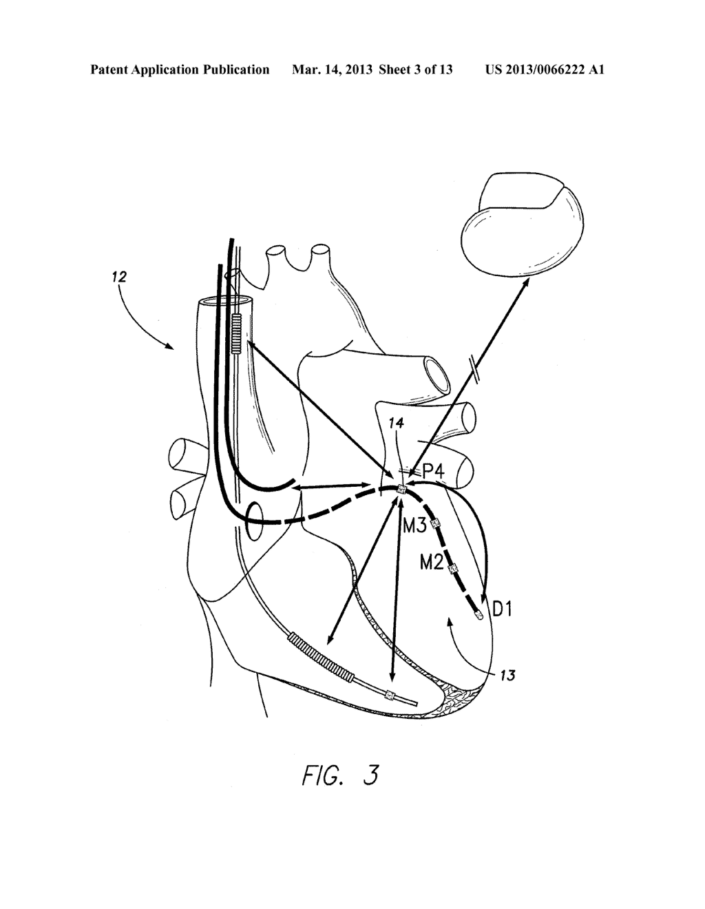 SYSTEMS AND METHODS FOR DETECTING FAR-FIELD OVERSENSING BASED ON SIGNALS     SENSED BY THE PROXIMAL ELECTRODE OF A MULTIPOLAR LV LEAD - diagram, schematic, and image 04