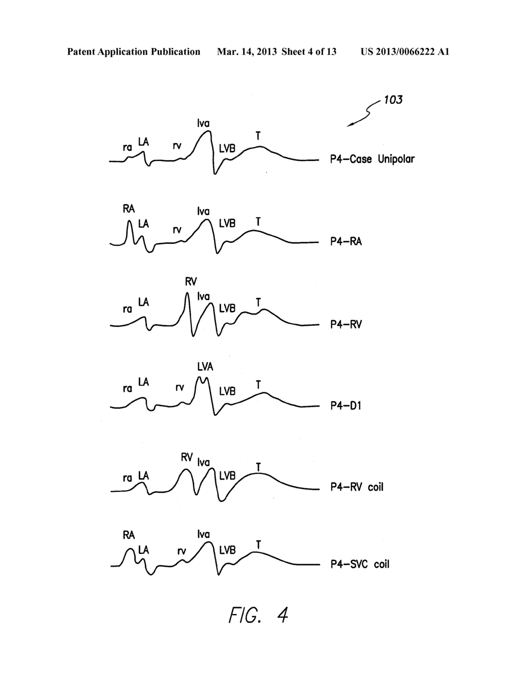 SYSTEMS AND METHODS FOR DETECTING FAR-FIELD OVERSENSING BASED ON SIGNALS     SENSED BY THE PROXIMAL ELECTRODE OF A MULTIPOLAR LV LEAD - diagram, schematic, and image 05
