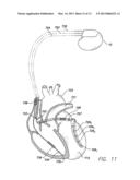 SYSTEMS AND METHODS FOR DETECTING FAR-FIELD OVERSENSING BASED ON SIGNALS     SENSED BY THE PROXIMAL ELECTRODE OF A MULTIPOLAR LV LEAD diagram and image