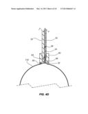 NORMALIZATION AND STABILIZATION OF BALLOON SURFACES FOR DEFLATION diagram and image