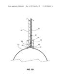 NORMALIZATION AND STABILIZATION OF BALLOON SURFACES FOR DEFLATION diagram and image