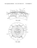 Corneal Denervation for Treatment of Ocular Pain diagram and image