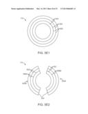 Corneal Denervation for Treatment of Ocular Pain diagram and image