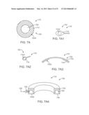 Corneal Denervation for Treatment of Ocular Pain diagram and image