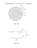 Corneal Denervation for Treatment of Ocular Pain diagram and image