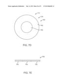 Corneal Denervation for Treatment of Ocular Pain diagram and image