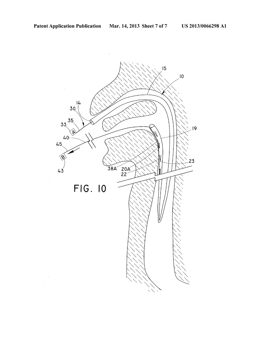 TUBULAR MEDICAL DEVICE - diagram, schematic, and image 08