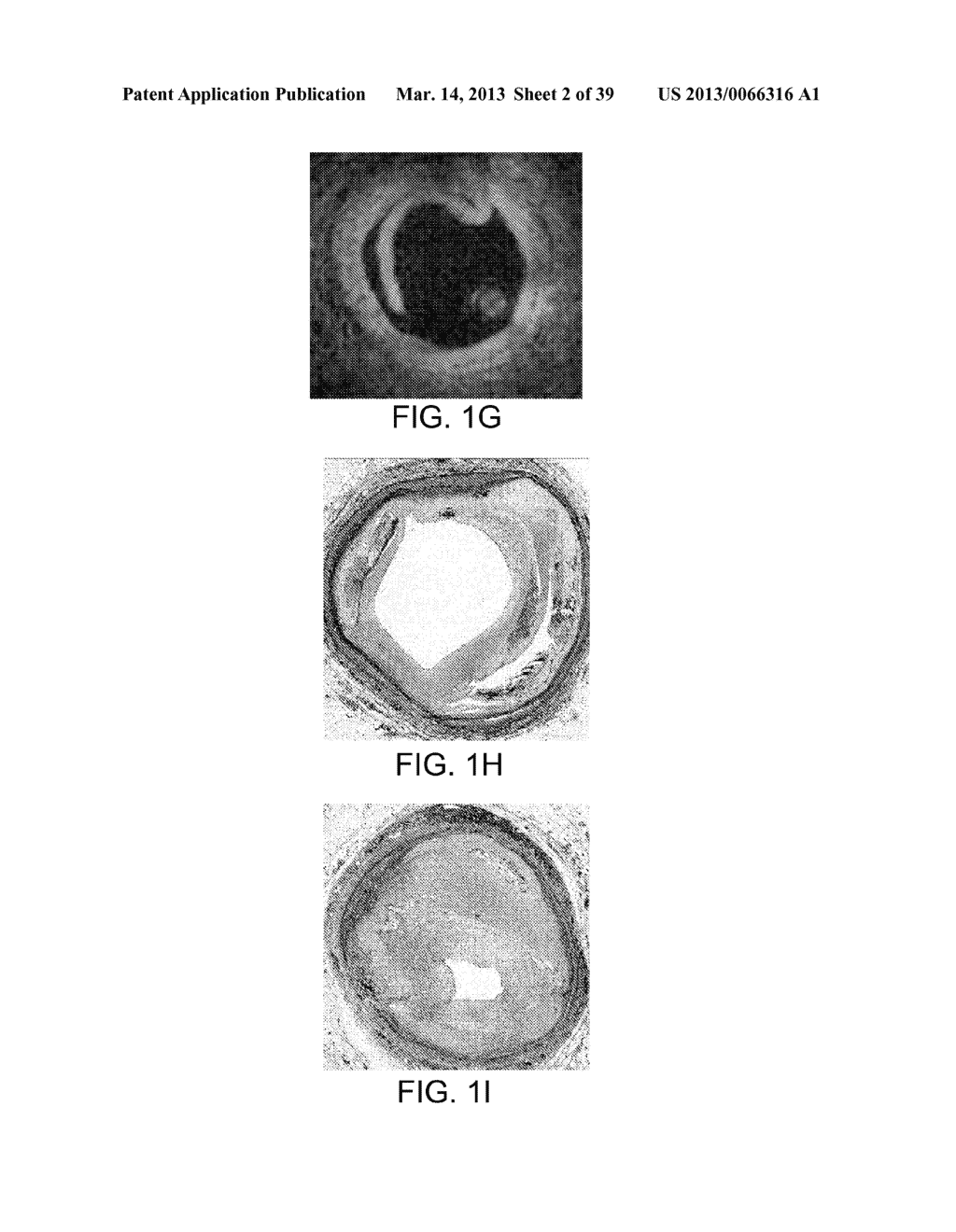 SELECTABLE ECCENTRIC REMODELING AND/OR ABLATION - diagram, schematic, and image 03