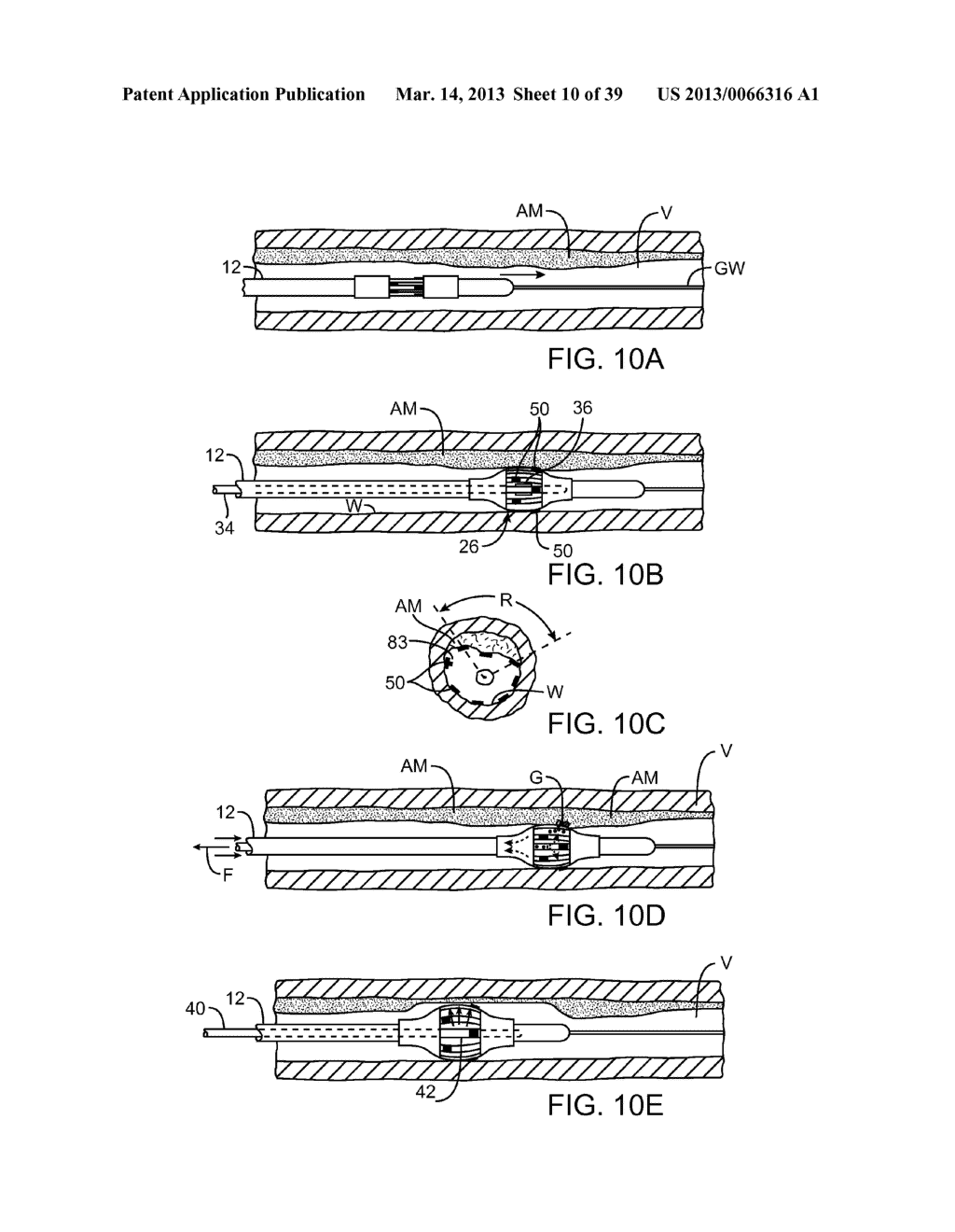 SELECTABLE ECCENTRIC REMODELING AND/OR ABLATION - diagram, schematic, and image 11