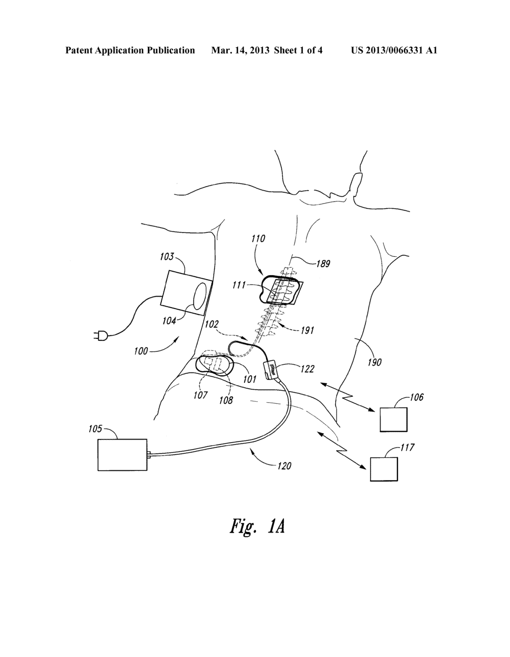 TAPERED, CURVED STYLETS FOR INSERTING SPINAL CORD MODULATION LEADS AND     ASSOCIATED SYSTEMS AND METHODS - diagram, schematic, and image 02