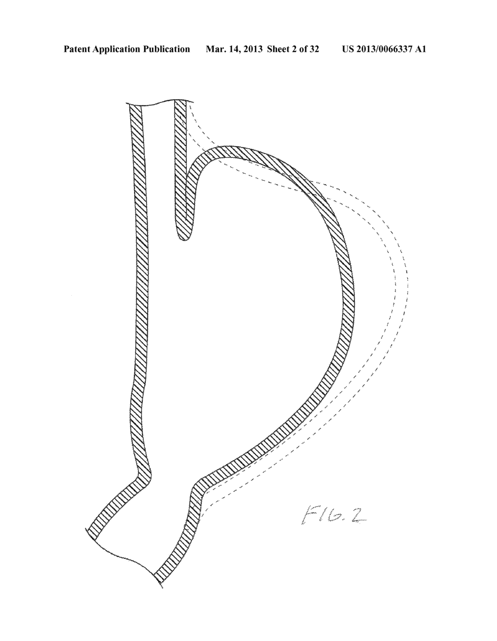 METHODS AND DEVICES FOR MANIPULATING AND FASTENING TISSUE - diagram, schematic, and image 03