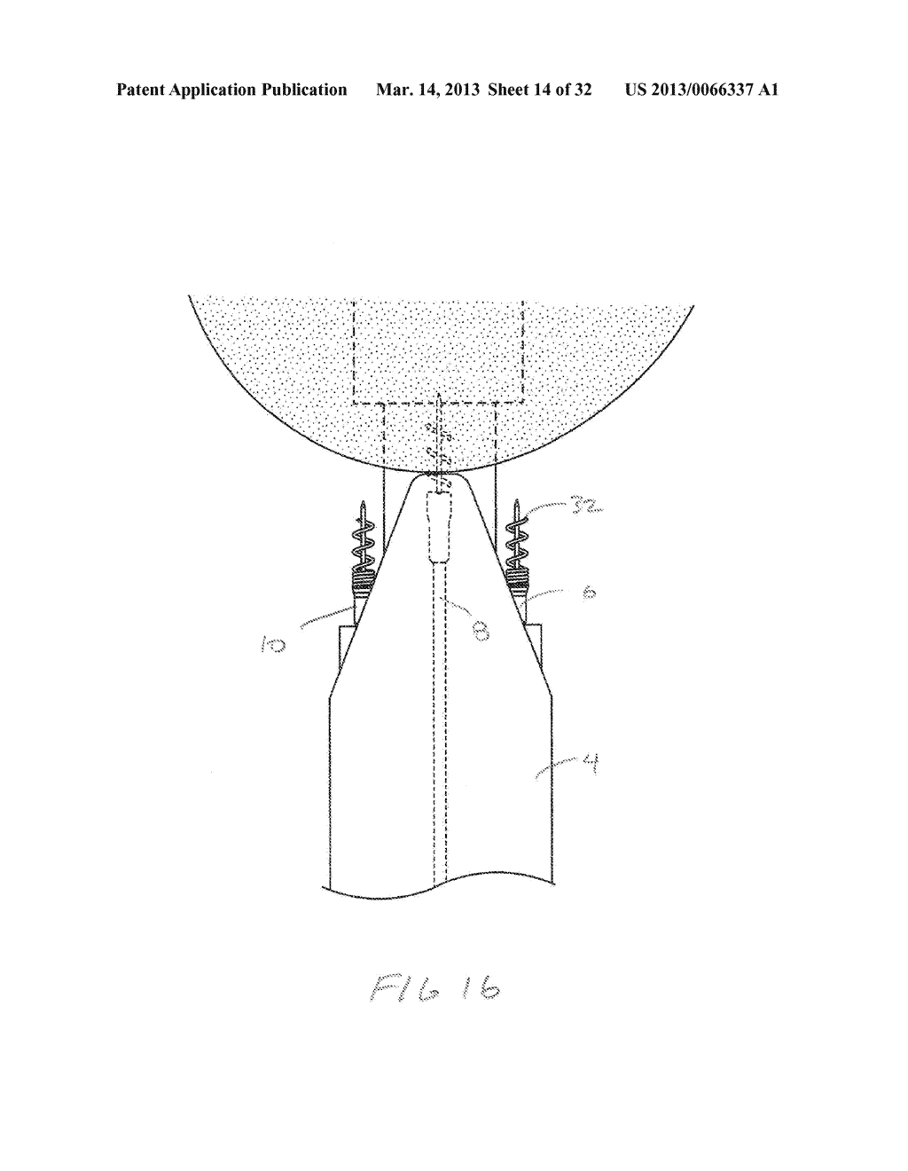 METHODS AND DEVICES FOR MANIPULATING AND FASTENING TISSUE - diagram, schematic, and image 15